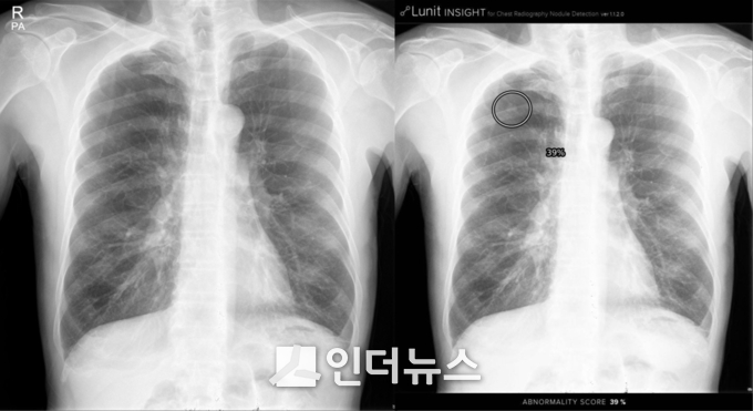‘루닛 인사이트‘ 구동 모습. 의심 위치와 악성 확률도 함께 보여준다. (사진제공 : 서울대학교 병원)